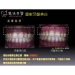 Teeth Whitening Trattamenti