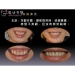 Full Mouth Dental Implants