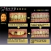 Dental Implants depan Gigi