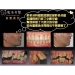 Cirurgia a Laser Periodontal