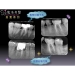 Root Canal Terapi