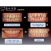 Sementara Dental Crown