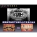 Chirurgischen Dental Implant