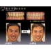 Chirurgie gingivale Flap