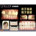 Laser Tooth Whitening